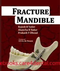 Fracture Mandible (pdf)